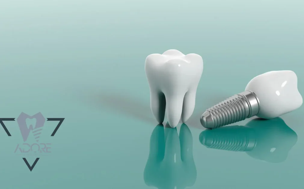 ایمپلنت آرگون چیست؟ انتخاب بهترین برند ایمپلنت آلمانی